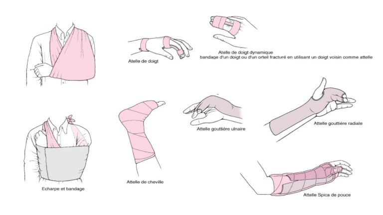 Comment Traiter Une Entorse Avec Les Premiers Soins – BDXQV